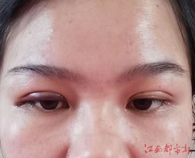 双眼皮埋线处长痘痘