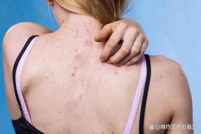 后背起粉刺什么原因