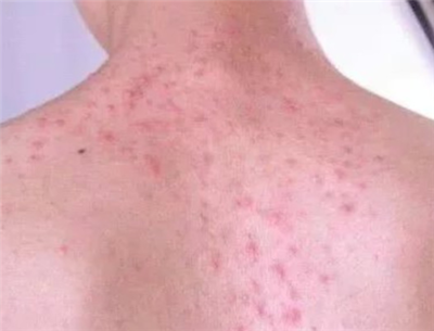 前胸长黑色的痘痘