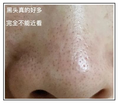粉刺挤掉好还是不挤好