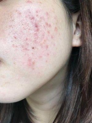 额头痘痘挤掉出现黑斑