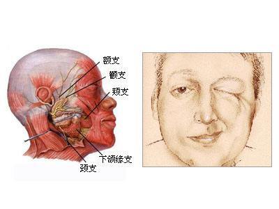 脸抽搐不停?面肌痉挛要注意这几大问题