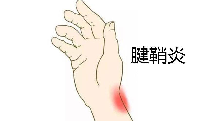 腱鞘炎怎么治疗好得快