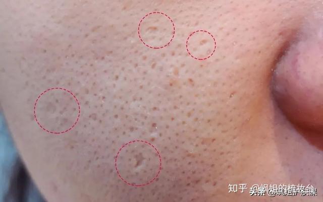 挤痘痘越来越肿