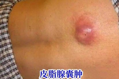 皮外囊肿怎么治疗