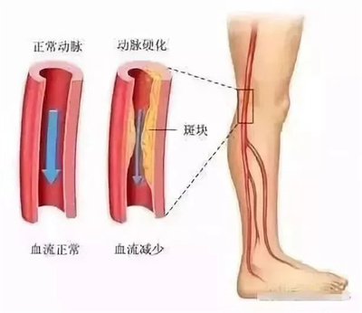 下肢缺血怎么治疗好